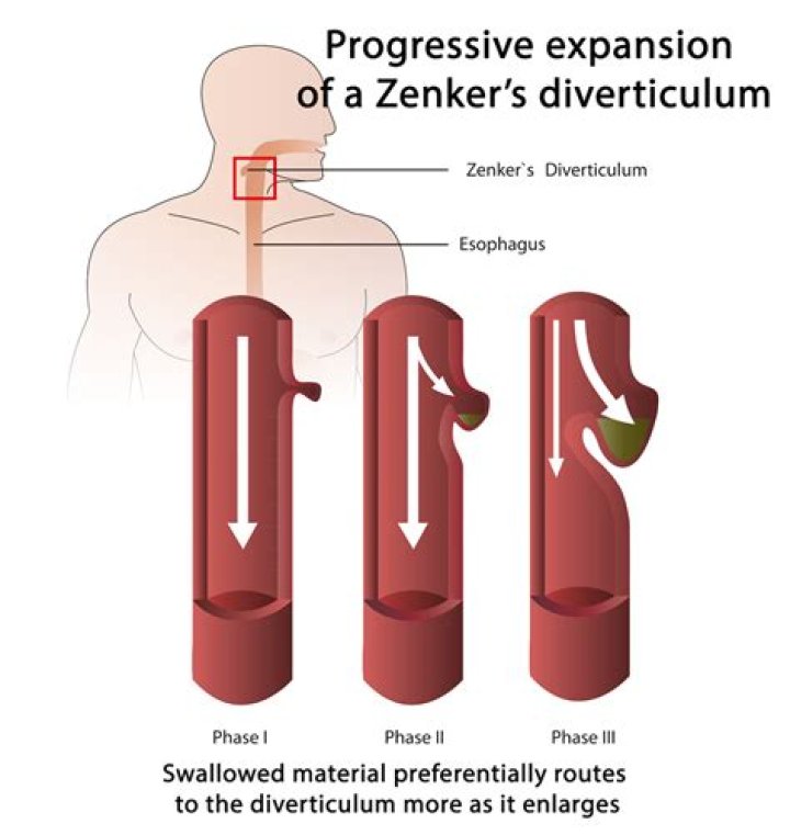 What is the ICD 10 code for Zenkers diverticulum